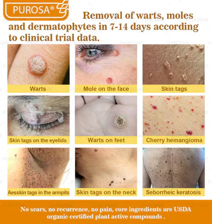 🐝PUROSA® Bee Venom Skin Treatment Cream, Anti-aging, Hydrating, Skin Repair, Even Tone, Acne and Dark Spot Treatment, Wart and Mole Removal, Psoriasis Relief